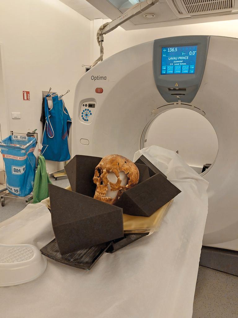 Scanner du crâne du patient « Lavau Prince ».